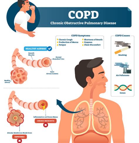Copd: it also meets non-smokers